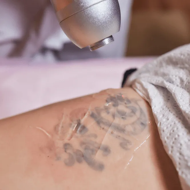 Tattoo removal